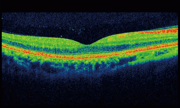 OTC scan