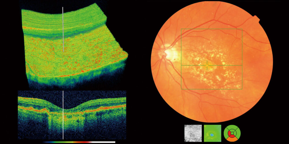 What is an OCT scan and why are OCT scans important?