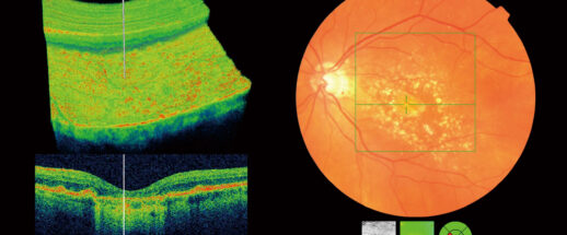 What is an OCT scan and why are OCT scans important?